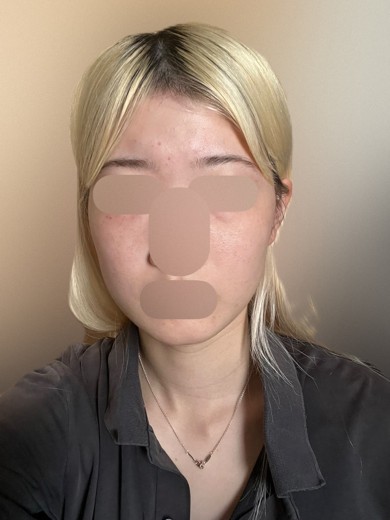 after photo: インモード