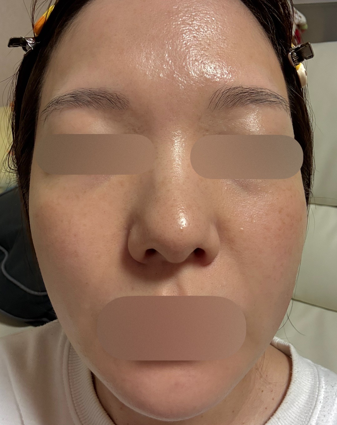 ピーリング　エレクトロポレーション エレクトロポレーション＋ピーリング | フォンタナクリニック天神