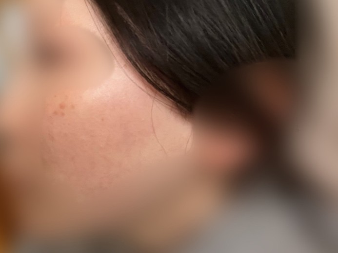 after photo: IPL(光/フォト治療)