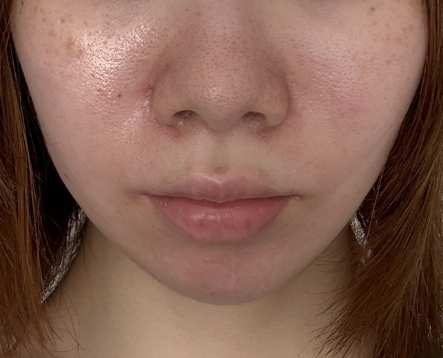 before photo: ハイドラフェイシャル