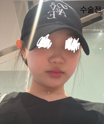 before photo: 비중격만곡증수술, 콧대(보형물), 코끝(자가연골), 비후성비염수술