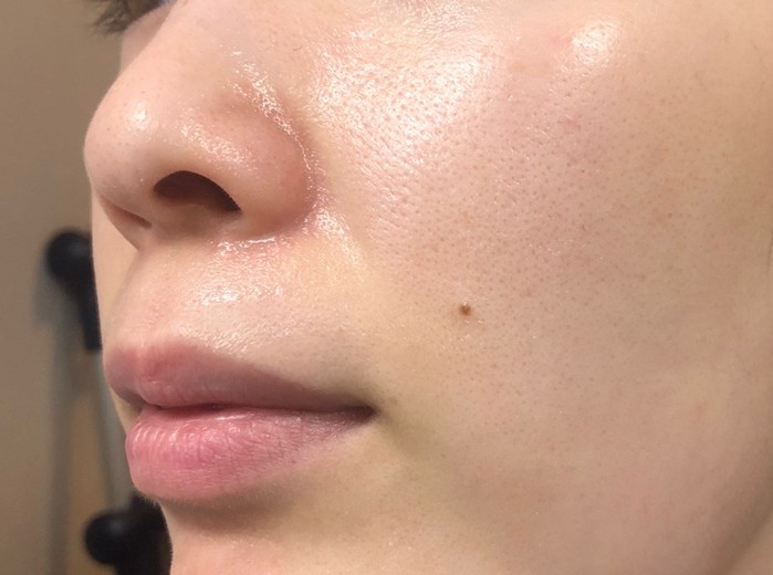 after photo: エレクトロポレーション