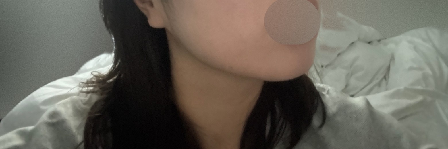 after photo: 윤곽주사, 얼굴지방분해주사