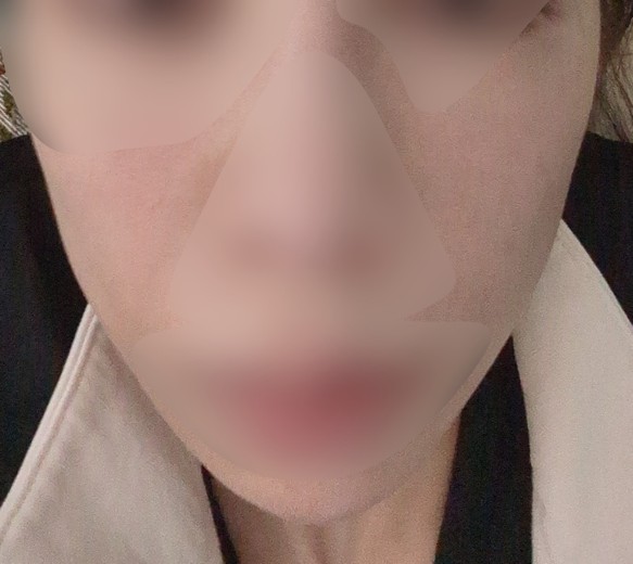 after photo: IPL(光/フォト治療)