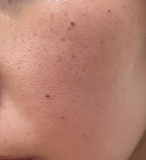 before photo: IPL(光/フォト治療)