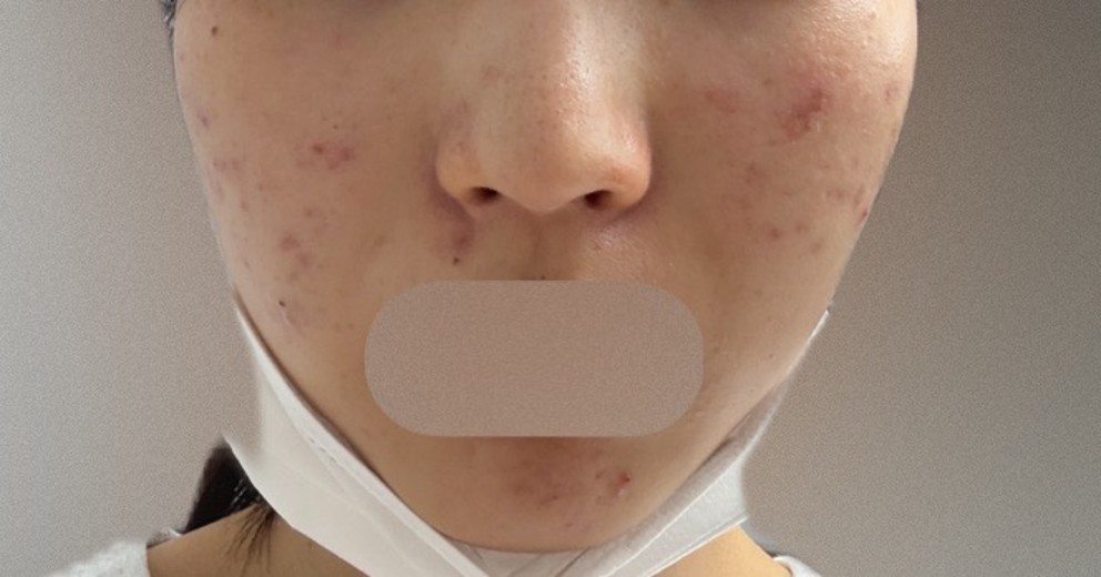 after photo: IPL(光/フォト治療), ピーリング, エレクトロポレーション, ルメッカ