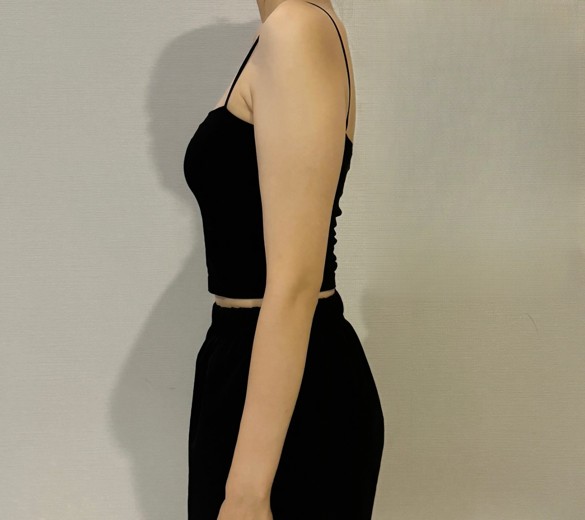 before photo: 팔지방흡입, 부유방흡입