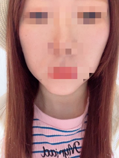 before photo: 糸リフト