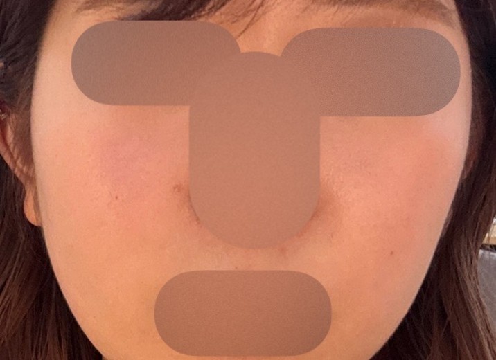 before photo: 脂肪溶解注射(脇腹), 脂肪溶解注射(顔)