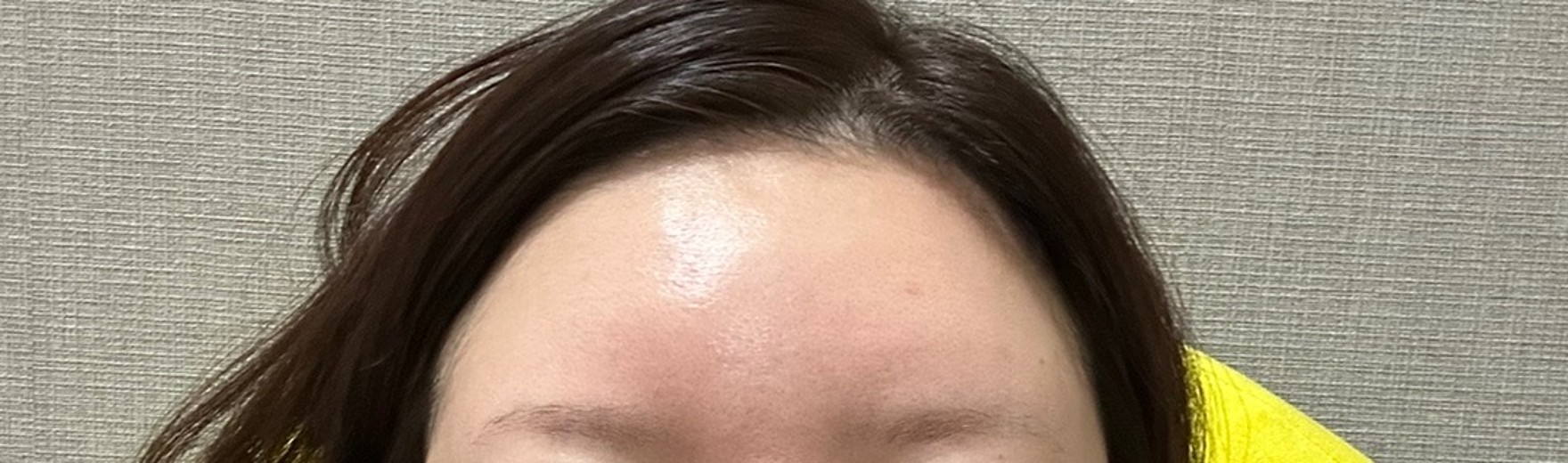 before photo: 額ヒアルロン酸