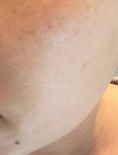 after photo: レーザーフェイシャル