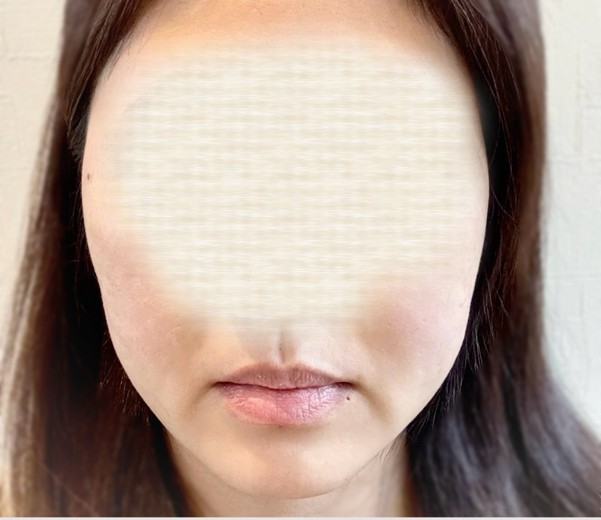 after photo: ボルニューマ