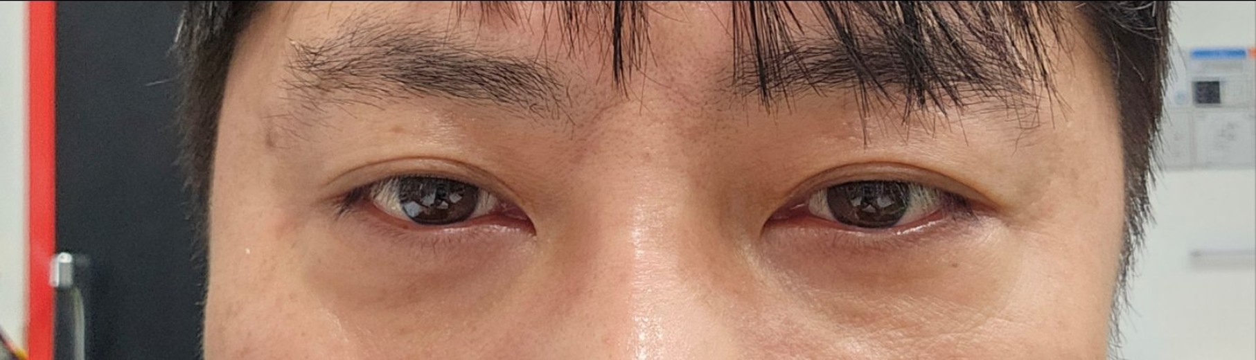 after photo: 눈밑지방재배치