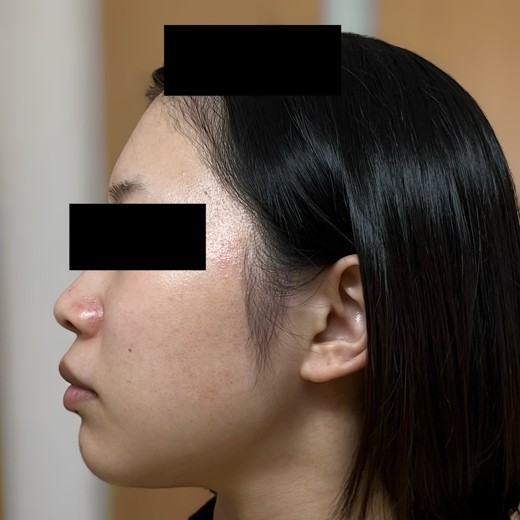 after photo: 脂肪溶解注射(顔)