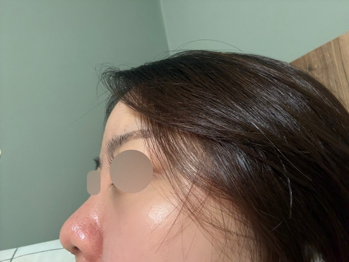 after photo: 콧대(보형물), 코끝(자가연골), 복코교정(수술)