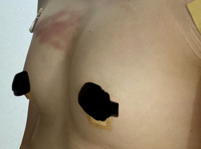 after photo: 豊胸(脂肪注入)
