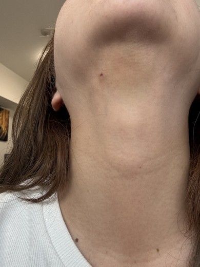 after photo: 脂肪吸引注射