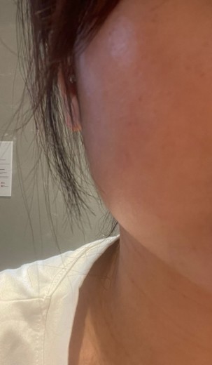 after photo: 인모드리프팅