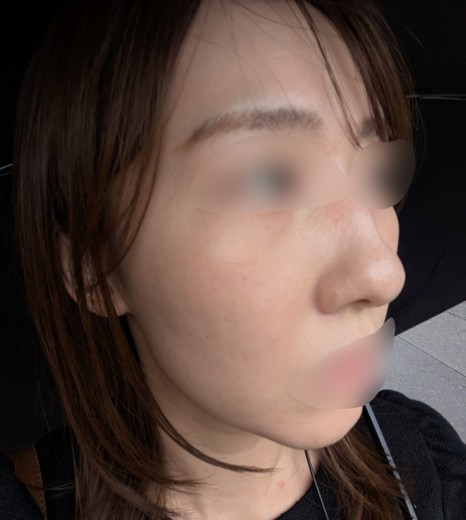 after photo: IPL(光/フォト治療), ピーリング