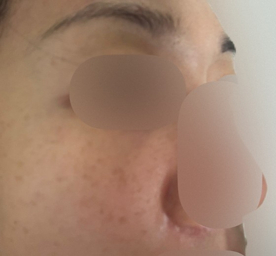 before photo: 아쿠아필링