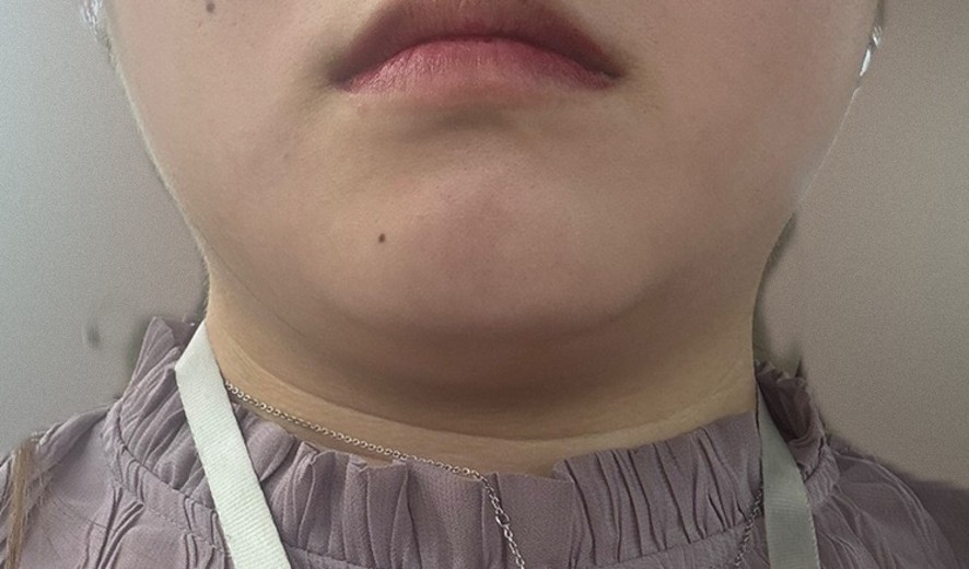 after photo: 脂肪溶解注射(顔)