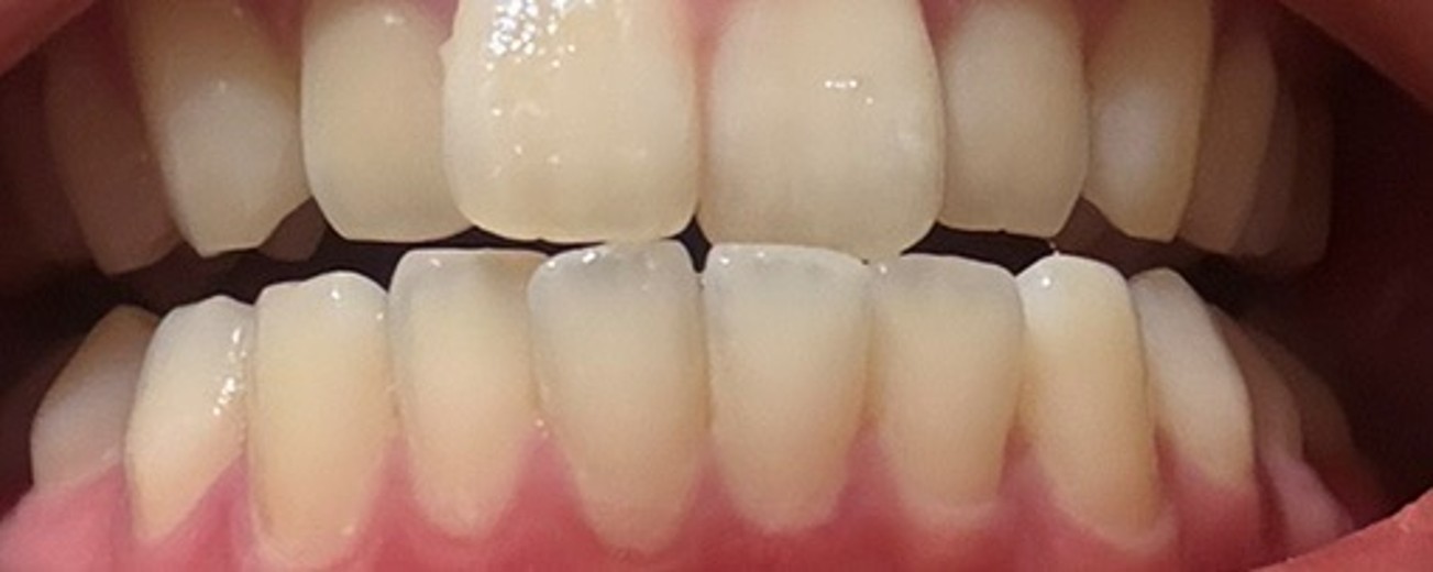 after photo: ホワイトニング