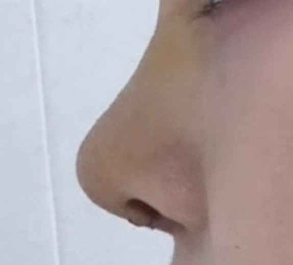 after photo: 콧대(보형물), 코끝(자가연골)