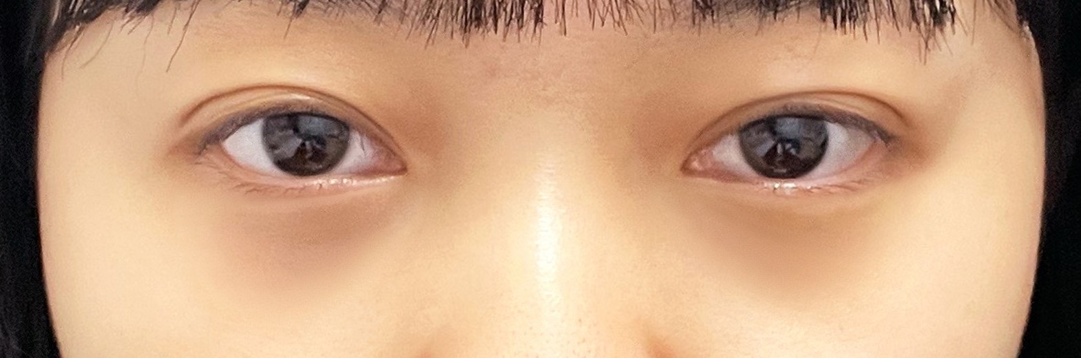 after photo: 눈밑지방재배치