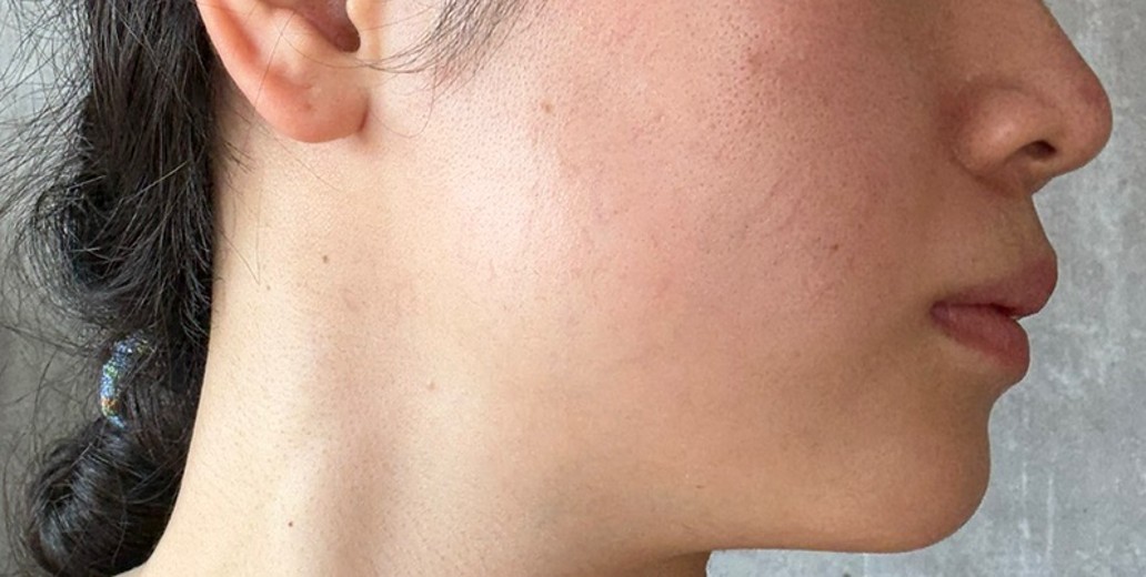 after photo: チタニウムリフト