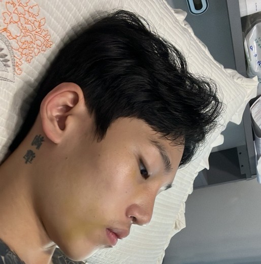 after photo: 코끝(보형물)