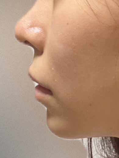 after photo: チタニウムリフト