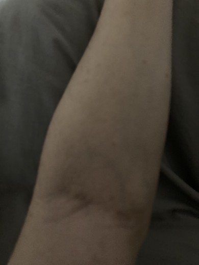 after photo: エクソソーム, 美容注射・点滴