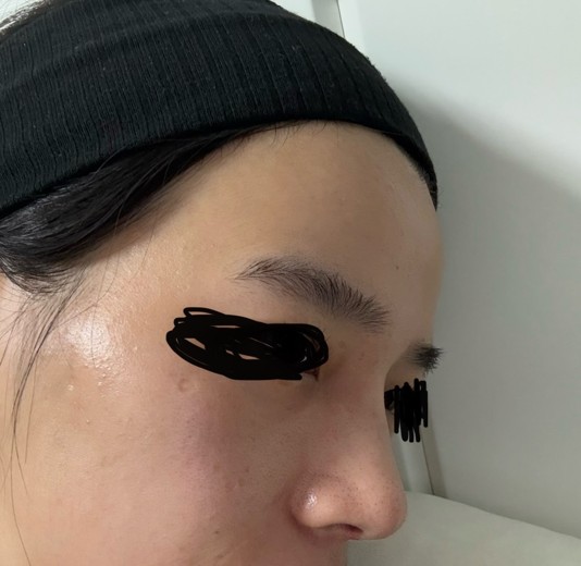 after photo: 비중격만곡증수술