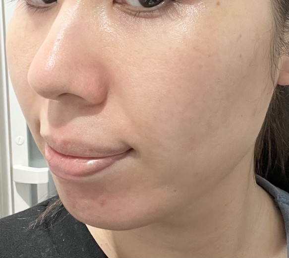 after photo: ジュベルック(Juvelook), サブシジョン(ニキビ跡治療)
