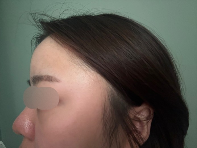 after photo: 콧대(보형물), 코끝(자가연골), 복코교정(수술)