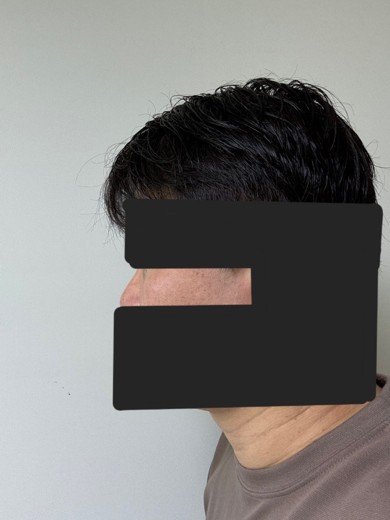 after photo: 눈밑지방재배치