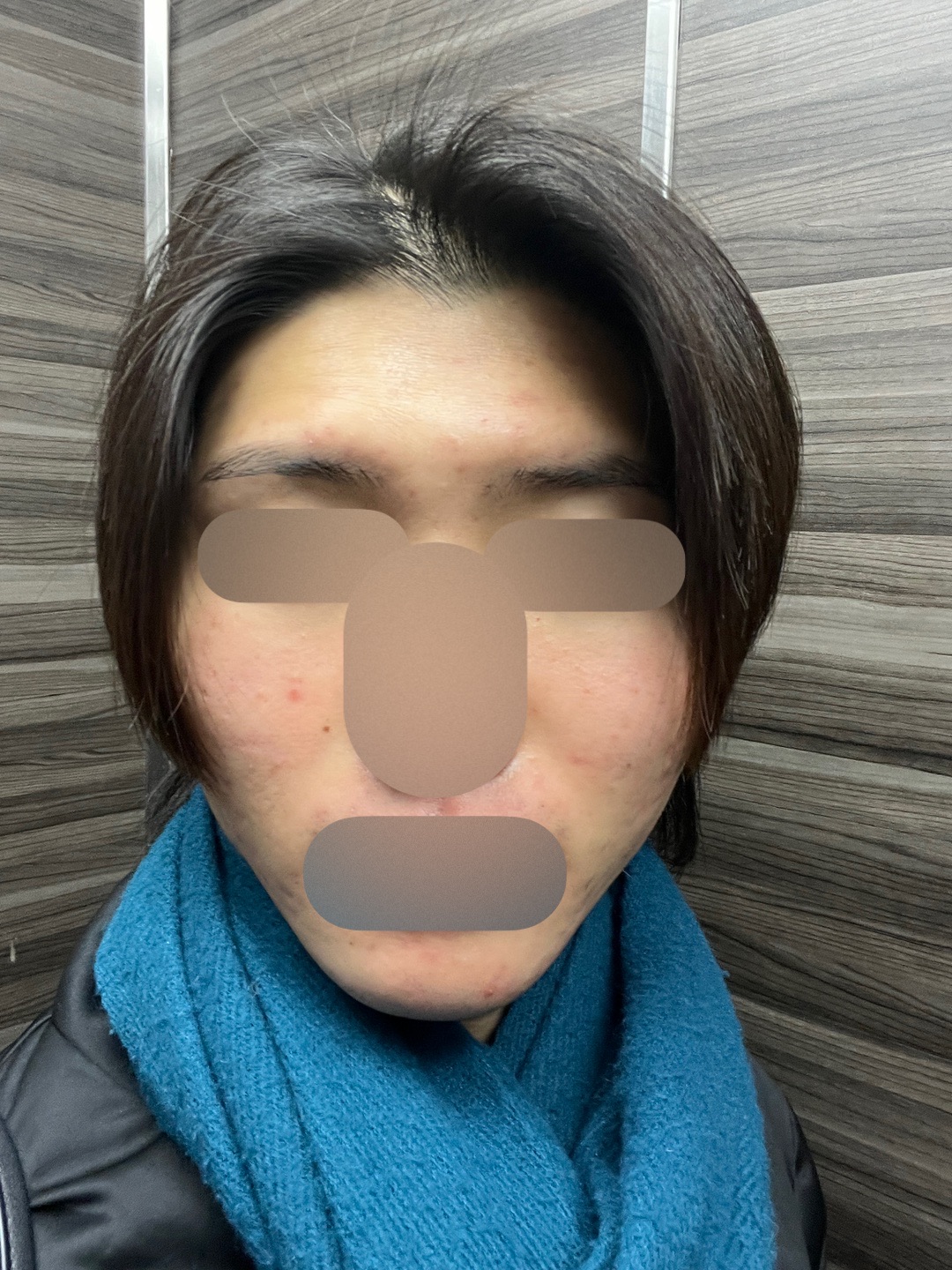 エレクトロポレーション全顔 【選べる薬剤1種付き】 | Karis Beauty Clinic