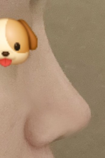 after photo: 콧대(보형물), 코끝(보형물)