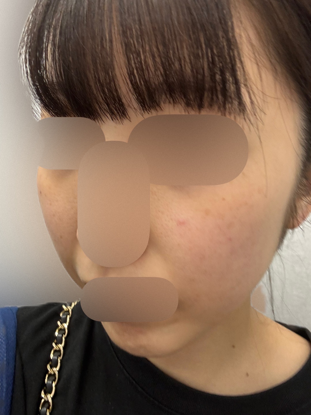 イオン導入（ビタミンC・トラネキサム酸） | PLACER CLINIC（プラセル