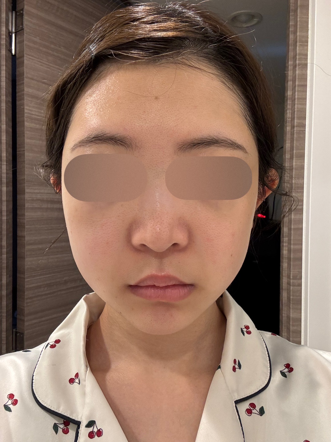一代エレクトロポレーション　ハイドラフェイシャル エレクトロポレーション（イオン導入）｜美容皮膚科なら湘南美容