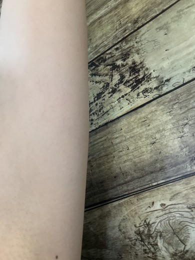after photo: 脂肪冷却(腕)