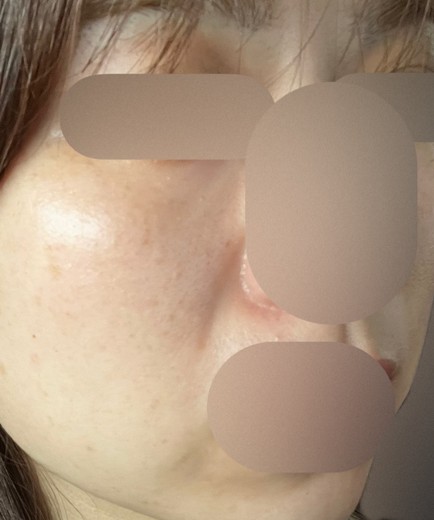 before photo: レーザートーニング, 診断・検査