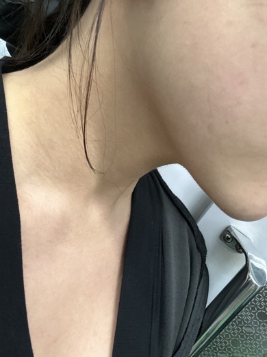 after photo: 침샘보톡스