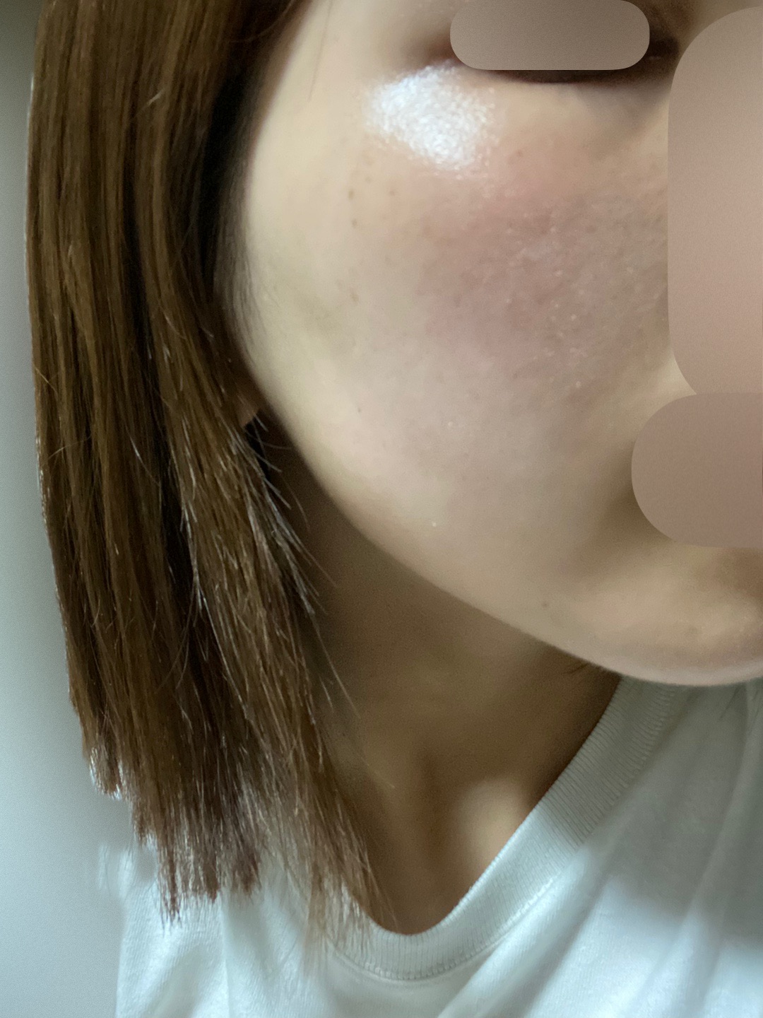 エレクトロポレーション エレクトロポレーション（イオン導入）｜美容皮膚科なら湘南美容