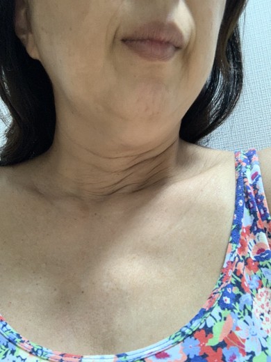 after photo: ハイフ(HIFU)