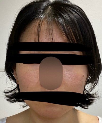 after photo: 白玉注射・点滴