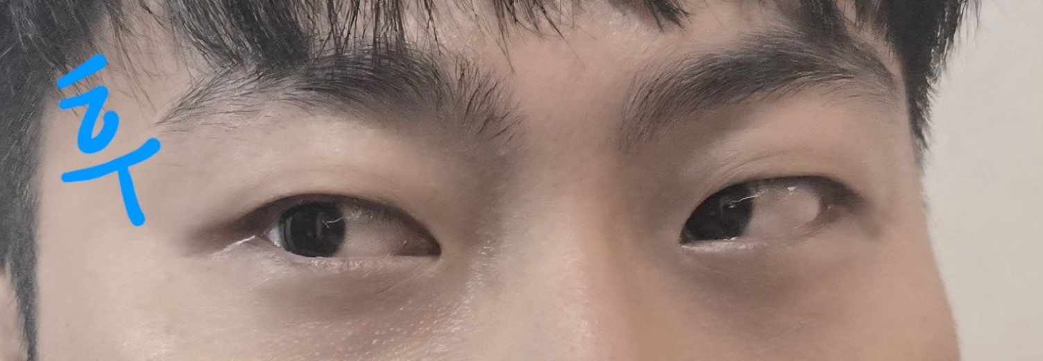 after photo: 입술필러