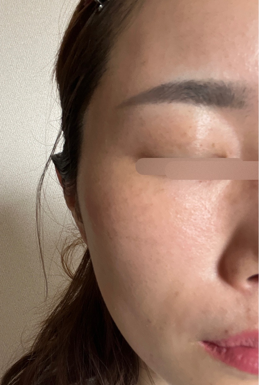 エレクトロポレーション エレクトロポレーション（イオン導入）｜美容皮膚科なら湘南美容