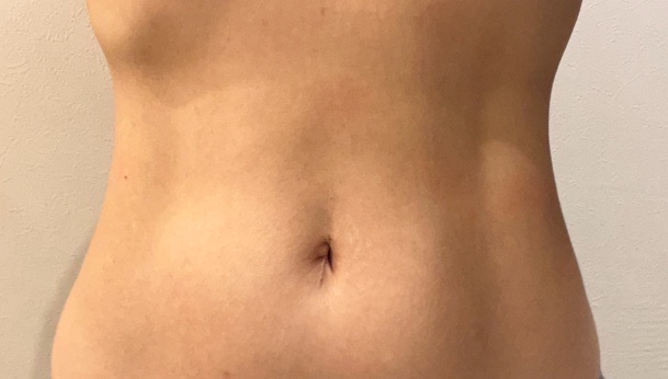 スノエル（脂肪冷却）2パーツ4ハンドル 部分痩せしたい方◎ | オルタ