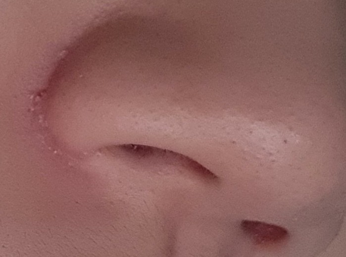 after photo: 콧볼축소